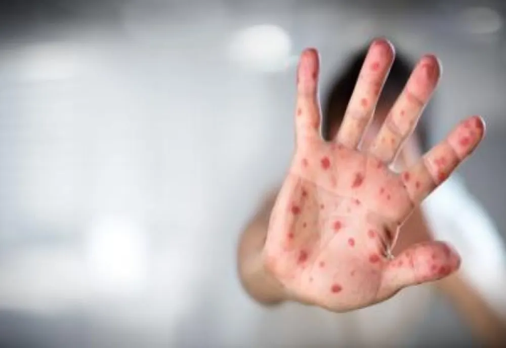 RUJEOLA RĂMÂNE O AMENINȚARE ÎN ROMÂNIA: PESTE 1.000 DE CAZURI RAPORTATE DOAR ÎN LUNA MAI 2025