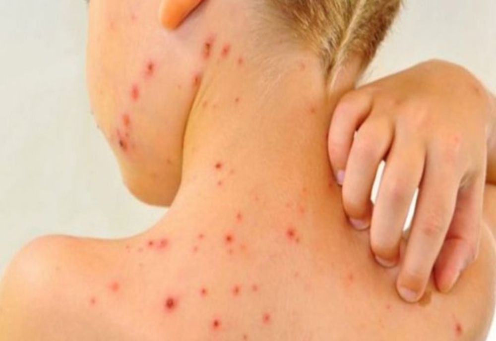 Noi cazuri de rujeolă confirmate în ultima săptămână